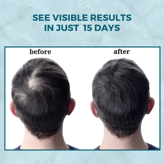 Hair Serum – Professional Procapil